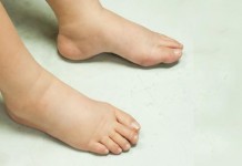 Kubu Raya Terbanyak Penderita Kaki Gajah