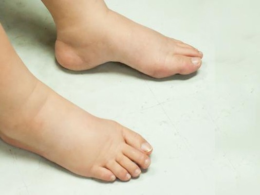 Kubu Raya Terbanyak Penderita Kaki Gajah