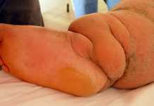 Sekadau Daerah Endemis Filariasis