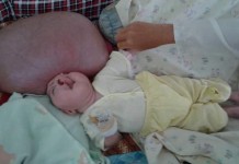 Tari Diduga Menderita Hidrosefalus