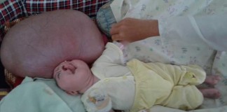 Tari Diduga Menderita Hidrosefalus