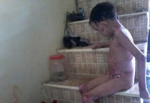 Kulit di Sekujur Tubuh Mengelupas