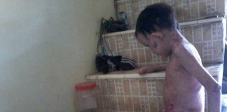 Kulit di Sekujur Tubuh Mengelupas