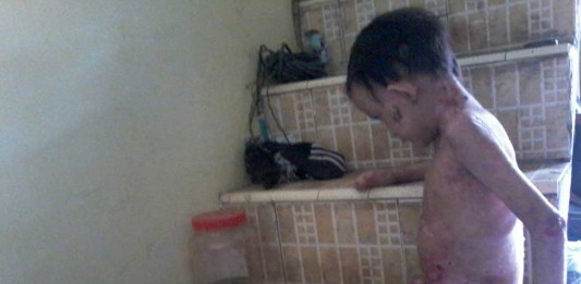 Kulit di Sekujur Tubuh Mengelupas