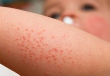 35 Kasus Flu Singapura Terjadi di Ketapang