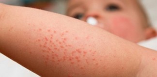 35 Kasus Flu Singapura Terjadi di Ketapang