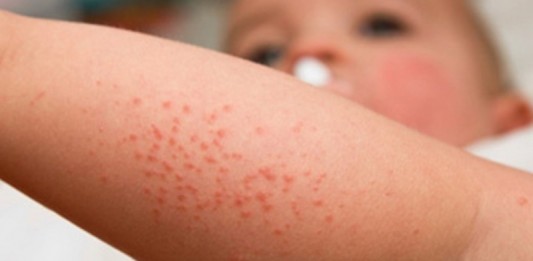 35 Kasus Flu Singapura Terjadi di Ketapang