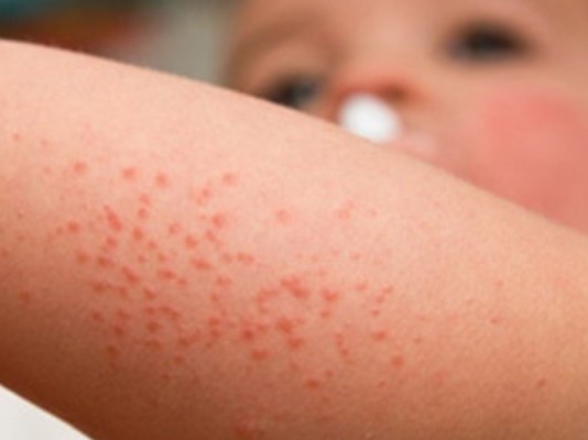 35 Kasus Flu Singapura Terjadi di Ketapang