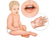 Puluhan Anak-anak Demam dan Gatal-gatal, Flu Singapura Mewabah di Ketapang