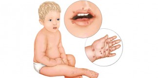 Puluhan Anak-anak Demam dan Gatal-gatal, Flu Singapura Mewabah di Ketapang