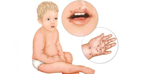 Puluhan Anak-anak Demam dan Gatal-gatal, Flu Singapura Mewabah di Ketapang