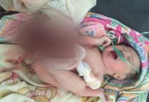 Lahir dengan Usus di Luar Perut