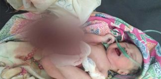 Lahir dengan Usus di Luar Perut