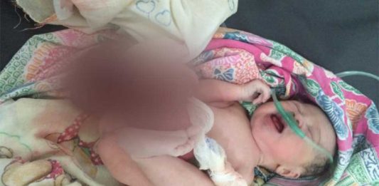 Lahir dengan Usus di Luar Perut