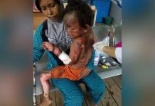 Tabung Gas Meledak, Tubuh Bocah Terbakar