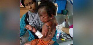 Tabung Gas Meledak, Tubuh Bocah Terbakar