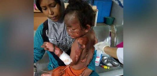 Tabung Gas Meledak, Tubuh Bocah Terbakar