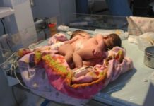 Ini Dia Bayi Kembar Siam Pertama di Sanggau