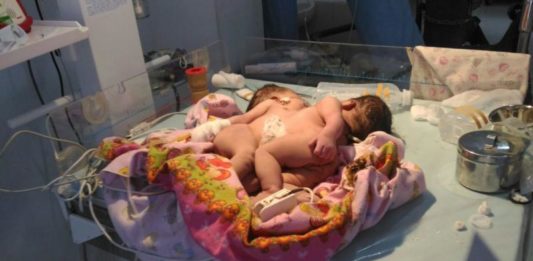 Ini Dia Bayi Kembar Siam Pertama di Sanggau