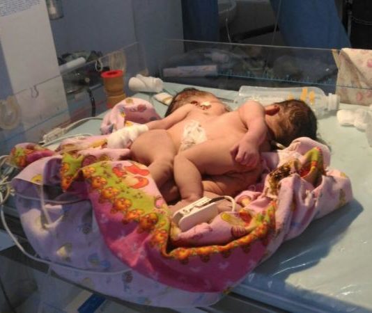 Ini Dia Bayi Kembar Siam Pertama di Sanggau