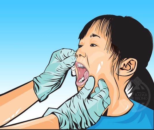 Mempawah Aman dari Difteri