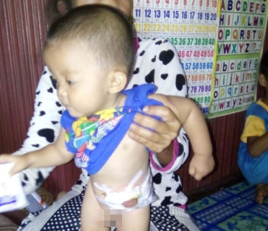 Jalani Operasi Kedua, Rafa Butuh Uluran Tangan BUTUH BANTUAN. Arnita dan anaknya Rafa Rafa Fauzan Kamil dikediamannya di Dusun Liang Desa Tekelak, Pinoh Utara, Melawi, Rabu (8/8). Dedi Irawan-RK