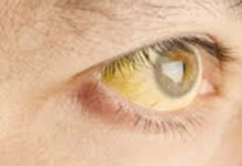 Hepatitis A di Kota Singkawang Tercatat Sebanyak 242 Kasus