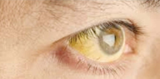 Hepatitis A di Kota Singkawang Tercatat Sebanyak 242 Kasus