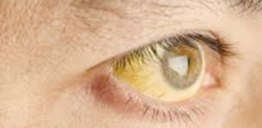 Hepatitis A di Kota Singkawang Tercatat Sebanyak 242 Kasus