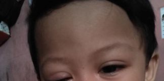 Tak Ada Dana Operasi Mata, Zakiarta Butuh Bantuan