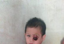 Tak Punya Biaya, Penderita Tumor Jalani Pengobatan Kampung