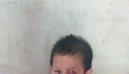 Tak Punya Biaya, Penderita Tumor Jalani Pengobatan Kampung