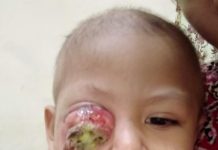 Zaki Akan Jalani Proses Kemoterapi Tahap Dua