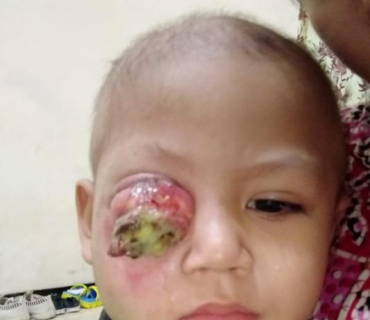 Zaki Akan Jalani Proses Kemoterapi Tahap Dua